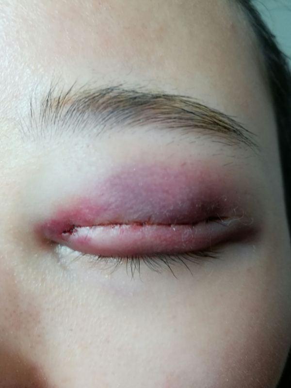 割双眼皮的后遗症你了解吗