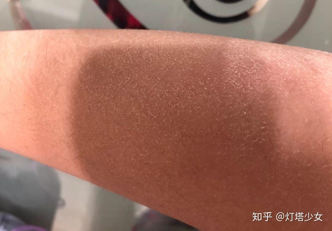 为什么一到冬天,脸上,身上干燥起皮掉皮屑?怎样科学的补水护肤?