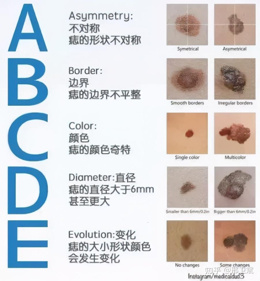 吉痣和恶痣的区别图片图片