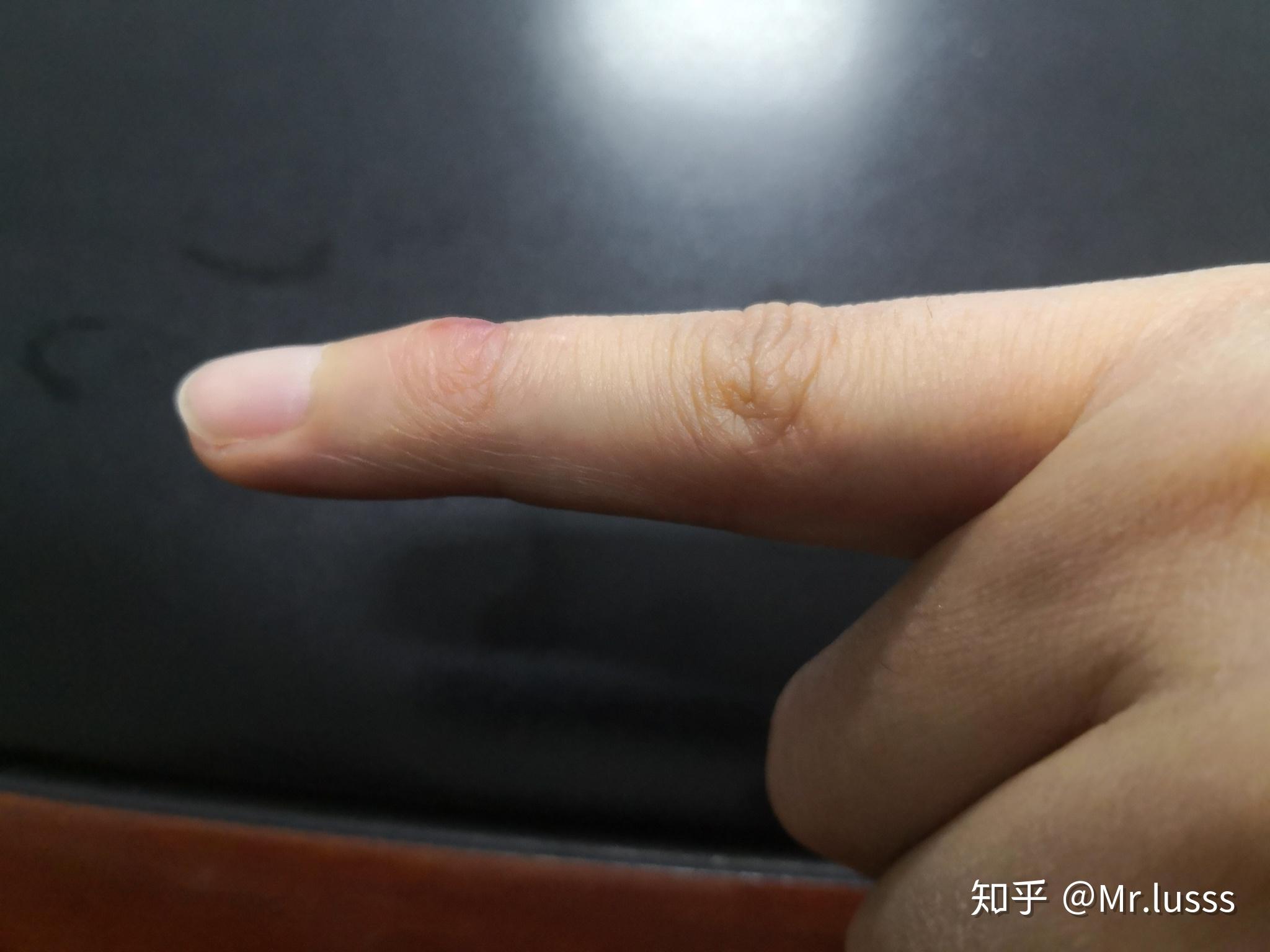 打篮球时手指戳伤不能伸直,求有经验的大神告诉我这是否严重啊!