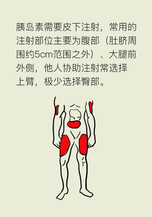 糖尿病患者真的了解胰岛素吗?