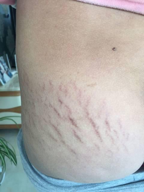 腿上长妊娠纹怎么办什么产品去除妊娠纹