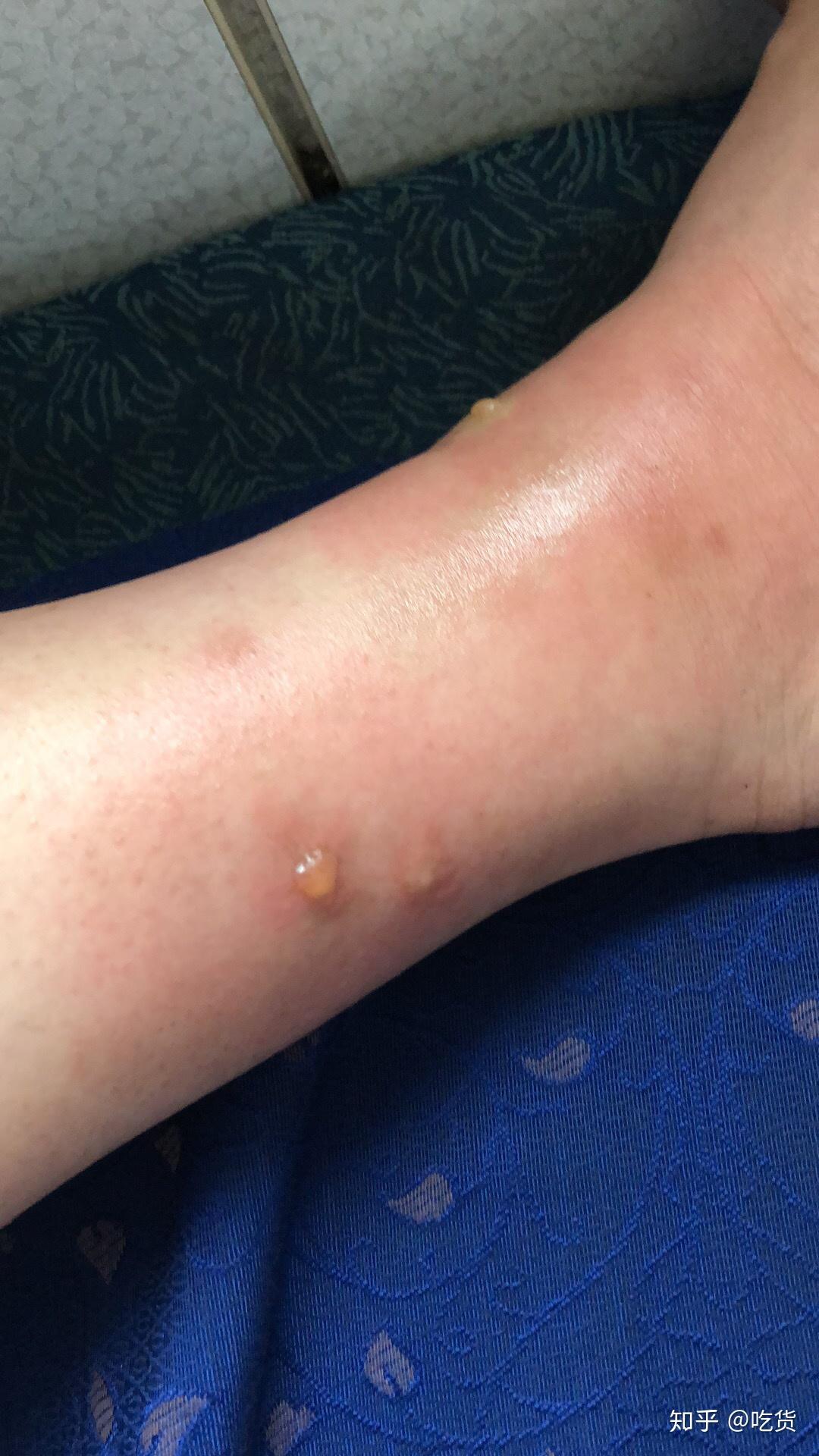 蚊子咬后肿大包之前没有这个状况什么原因