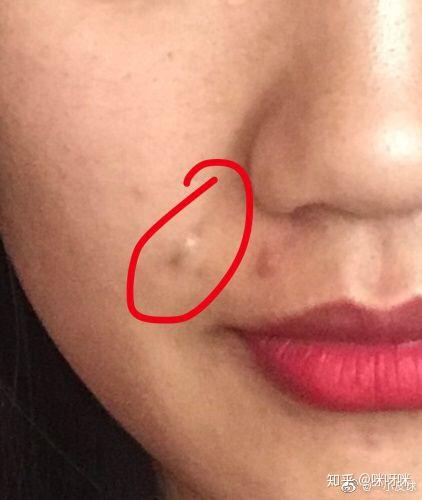 脸上长了个粉瘤有什么办法不开刀能处理掉