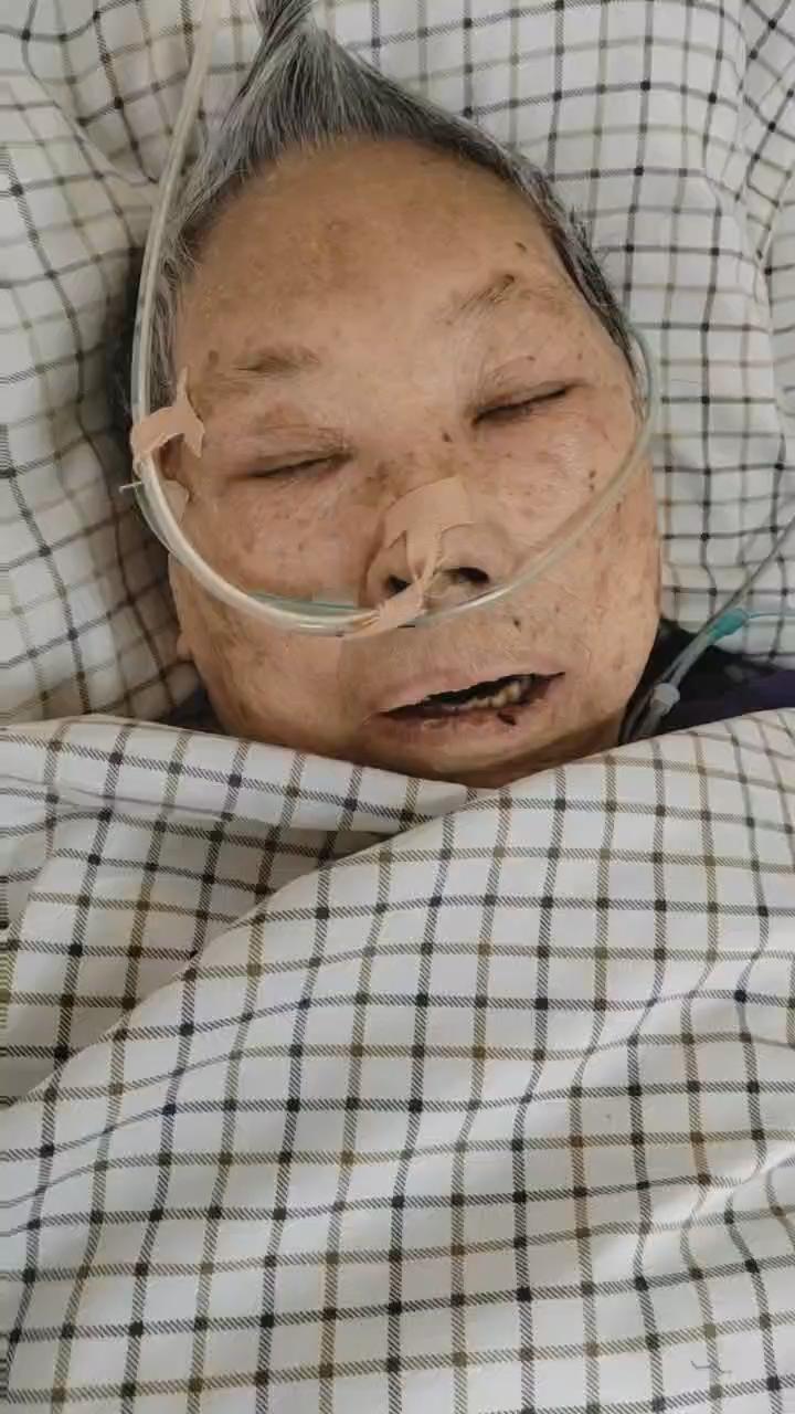  新冠肺炎后遗病有哪些表现(新冠肺炎后遗症有多可怕,咱们还是做好个人防护)