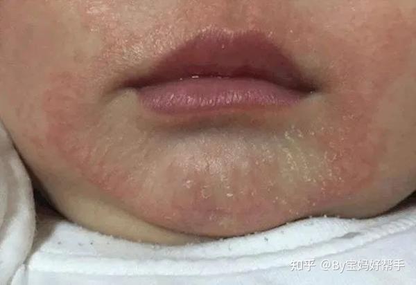 婴幼儿湿疹、急疹、热疹、痤疮、口水疹等10种皮肤病护理,一文搞定! - 知乎