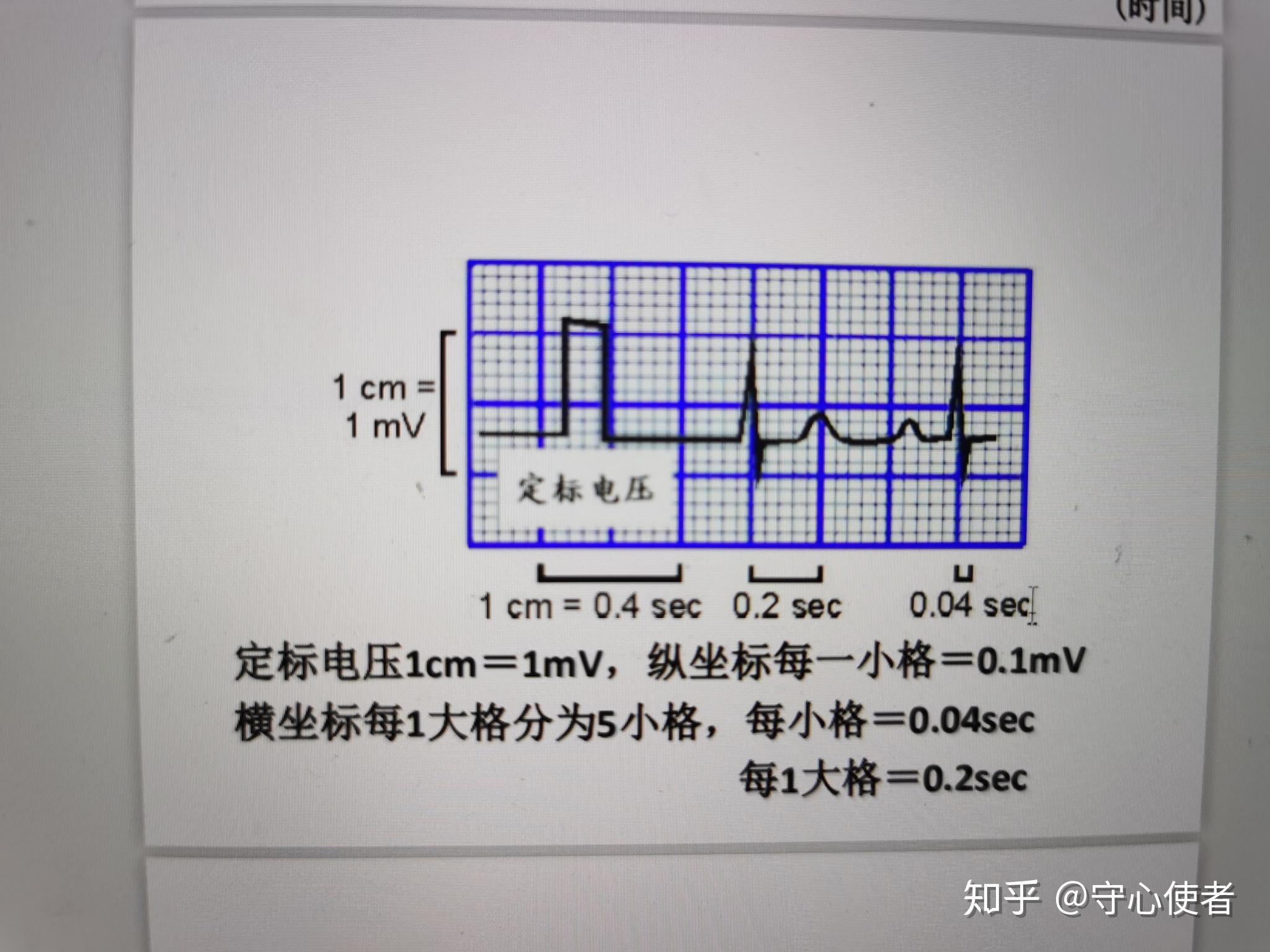 请问一下这张心电图可以看出rp时间嘛