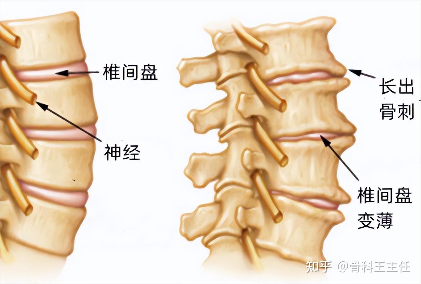 脖子僵硬疼痛颈椎病肌肉劳损椎间盘突出有什么区别