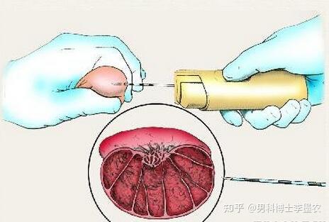 解读男性睾丸穿刺术!
