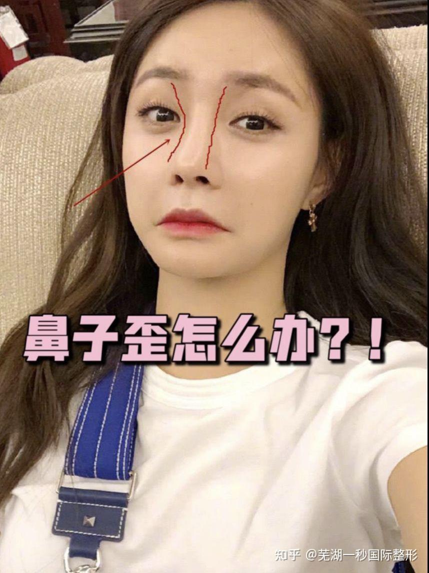 鼻子歪怎么办呀qaq可以说是很自卑了