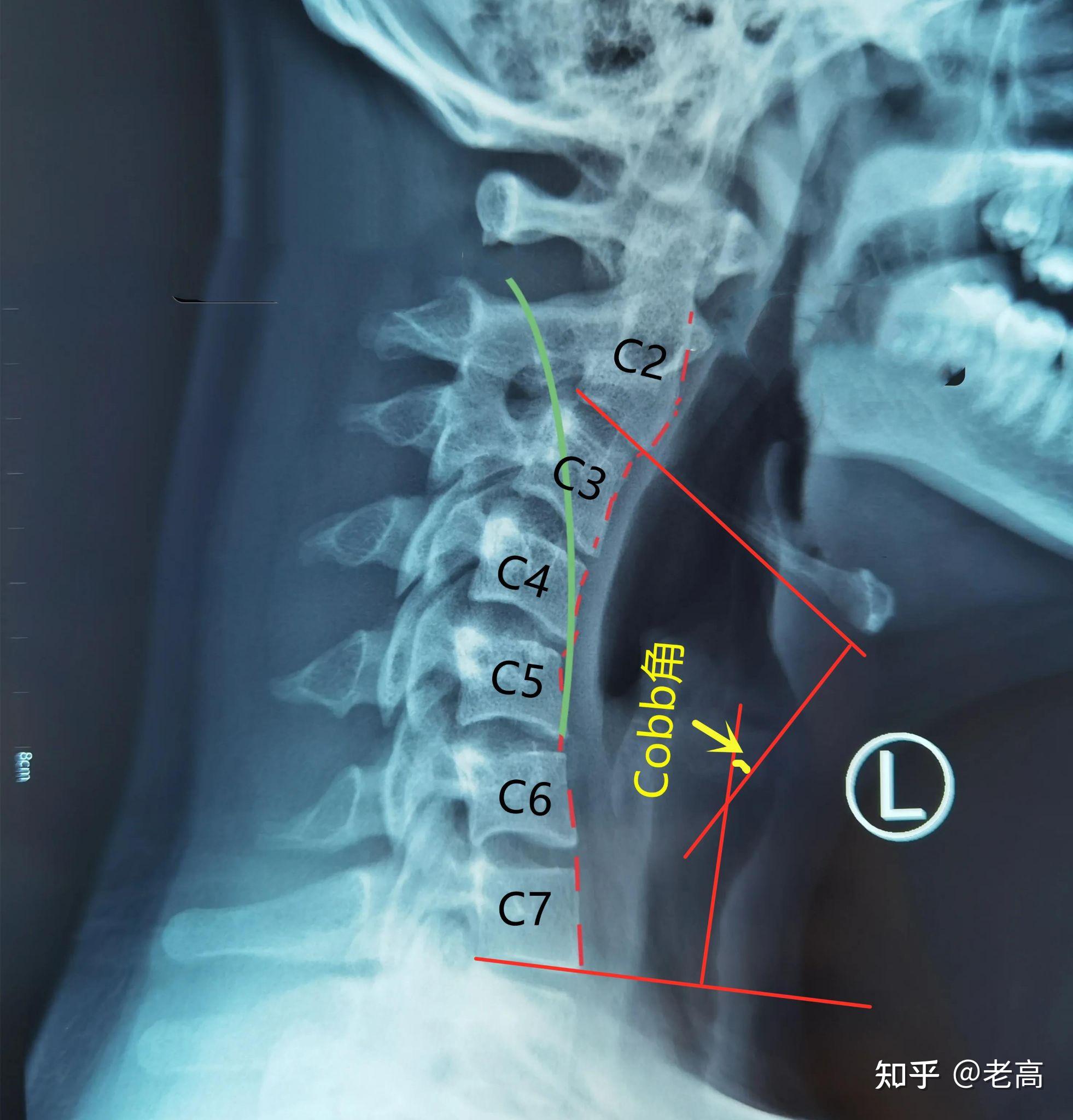 低头族对肩椎有多大影响呢? - 知乎