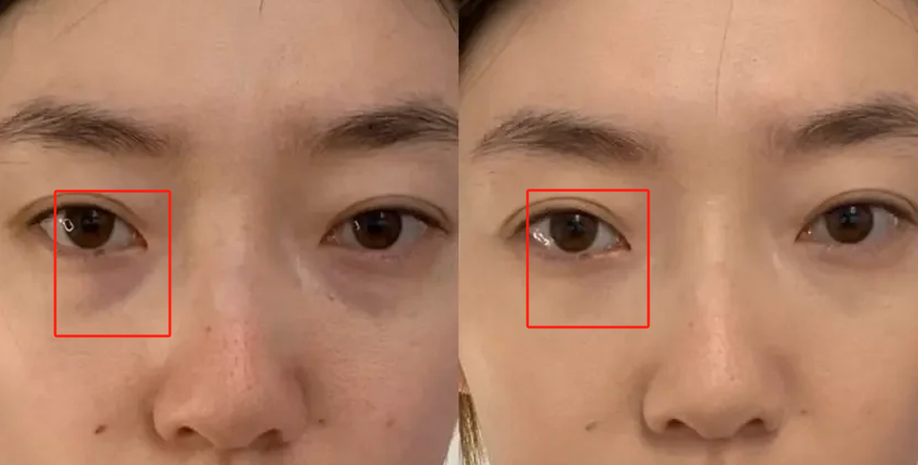 不动手术/打针/填充,泪沟有什么办法能去除?皮肤科医生教你3招,轻松摆平泪沟、给显老眼部减龄!