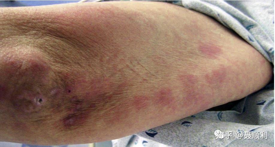 (pngd) 和间质性肉芽肿性皮炎(igd)是类风湿关节炎 (ra) 常见的皮肤