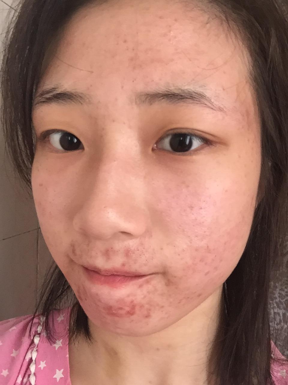 17岁女生因为脸上的痘坑对生活失去了信心