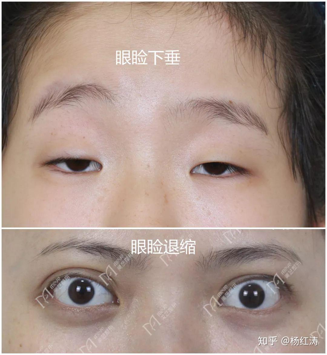福州爱尔眼科医院成功为一五岁男孩进行眼部手术-医院汇-丁香园