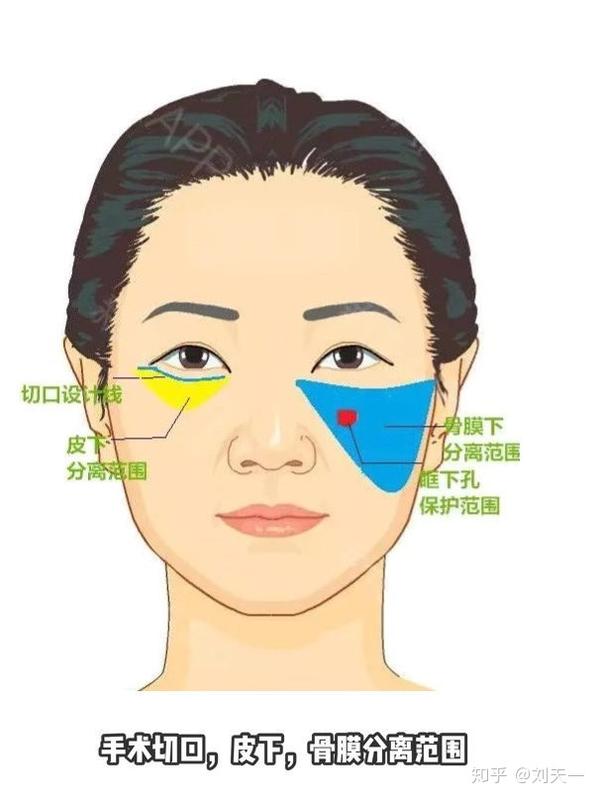 原创面中部拉皮主要解决什么问题