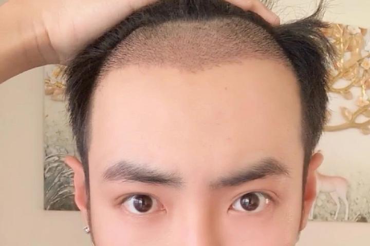 植发手术痛吗?真实经历者来告诉你 - 知乎
