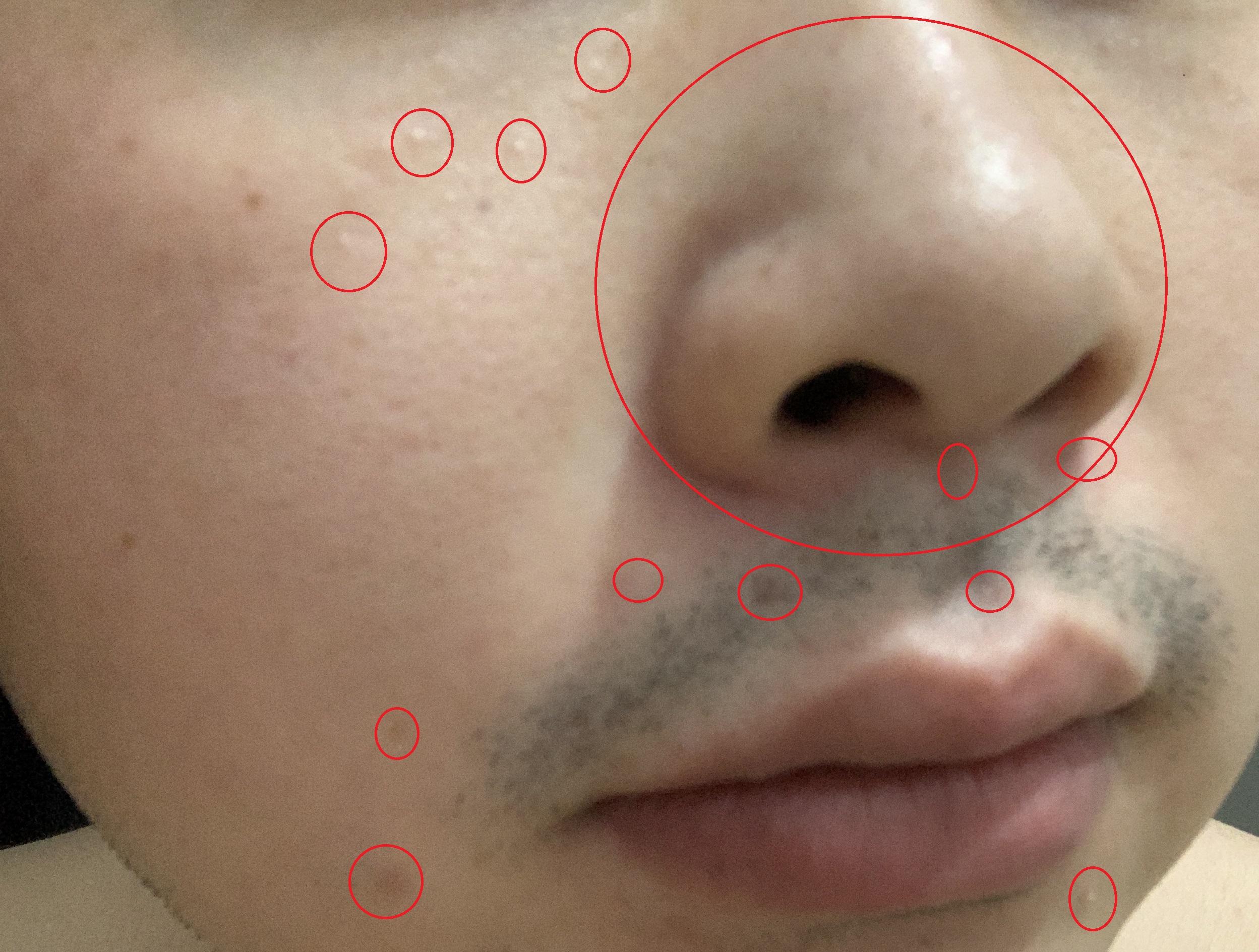 脸上的黑斑点是什么原因形成的？如何治疗？图_百度知道