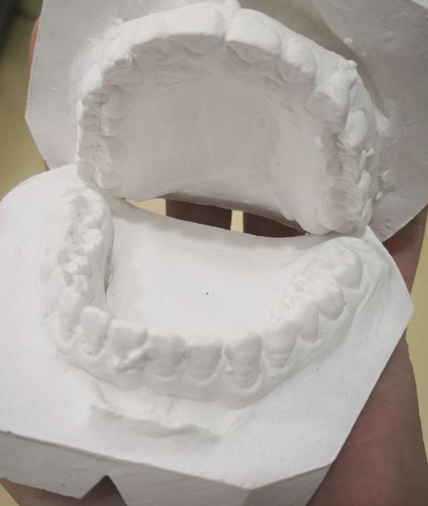 戴牙套(正畸)是什么体验?