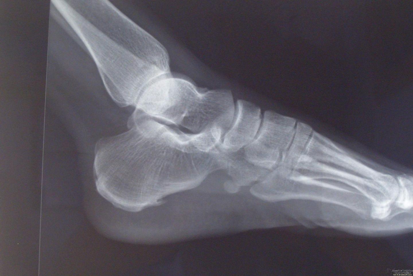 骨头上长了刺怎么破