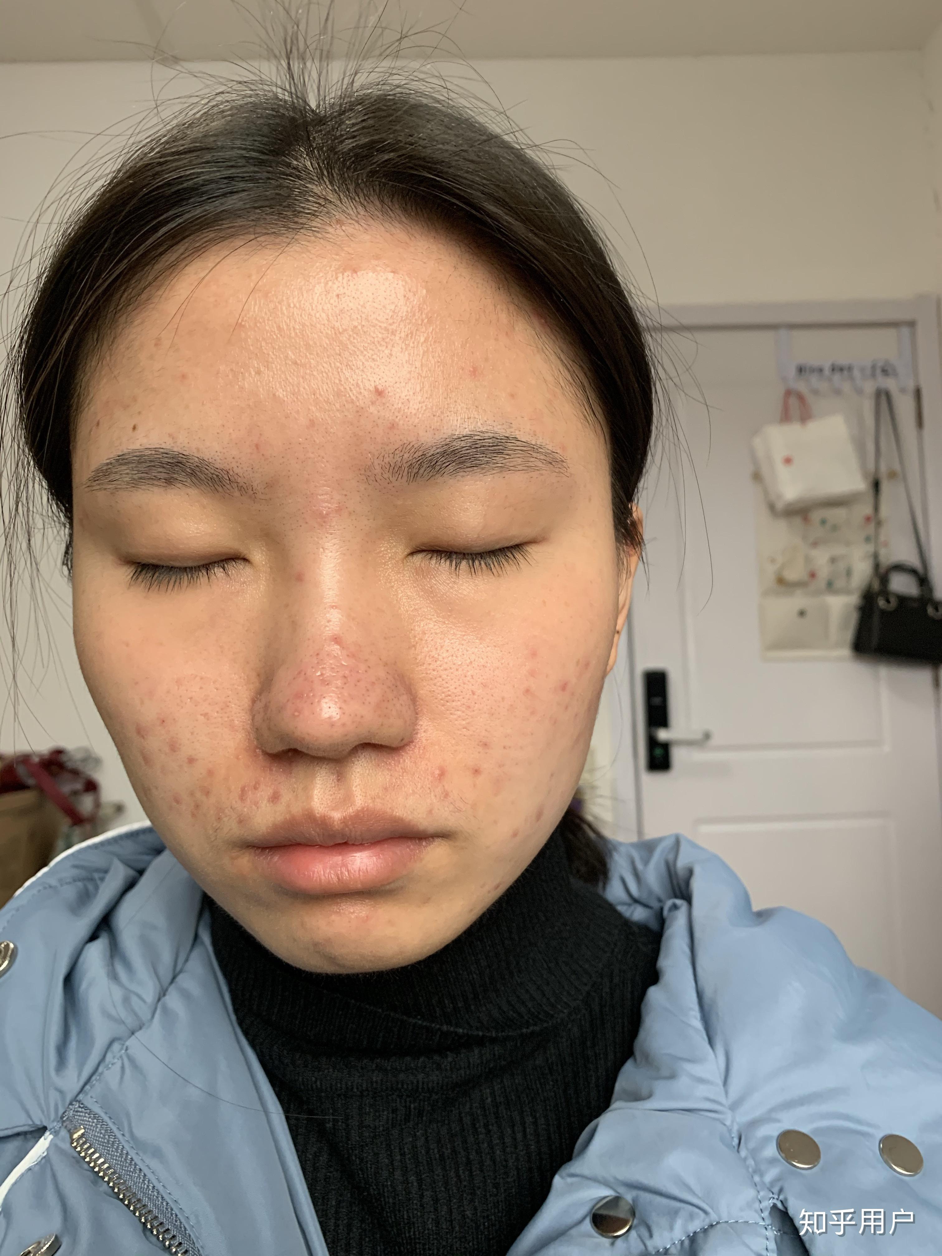 女孩子有酒糟鼻是什么样的体验?