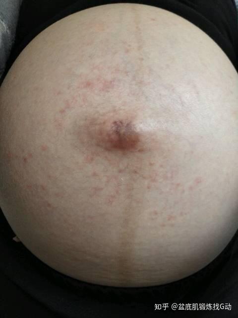 怀孕肚皮痒怎么解决啊 v2-a4f0dc0c95aae6b05f40d23ebe7ab8a8_r.jpg