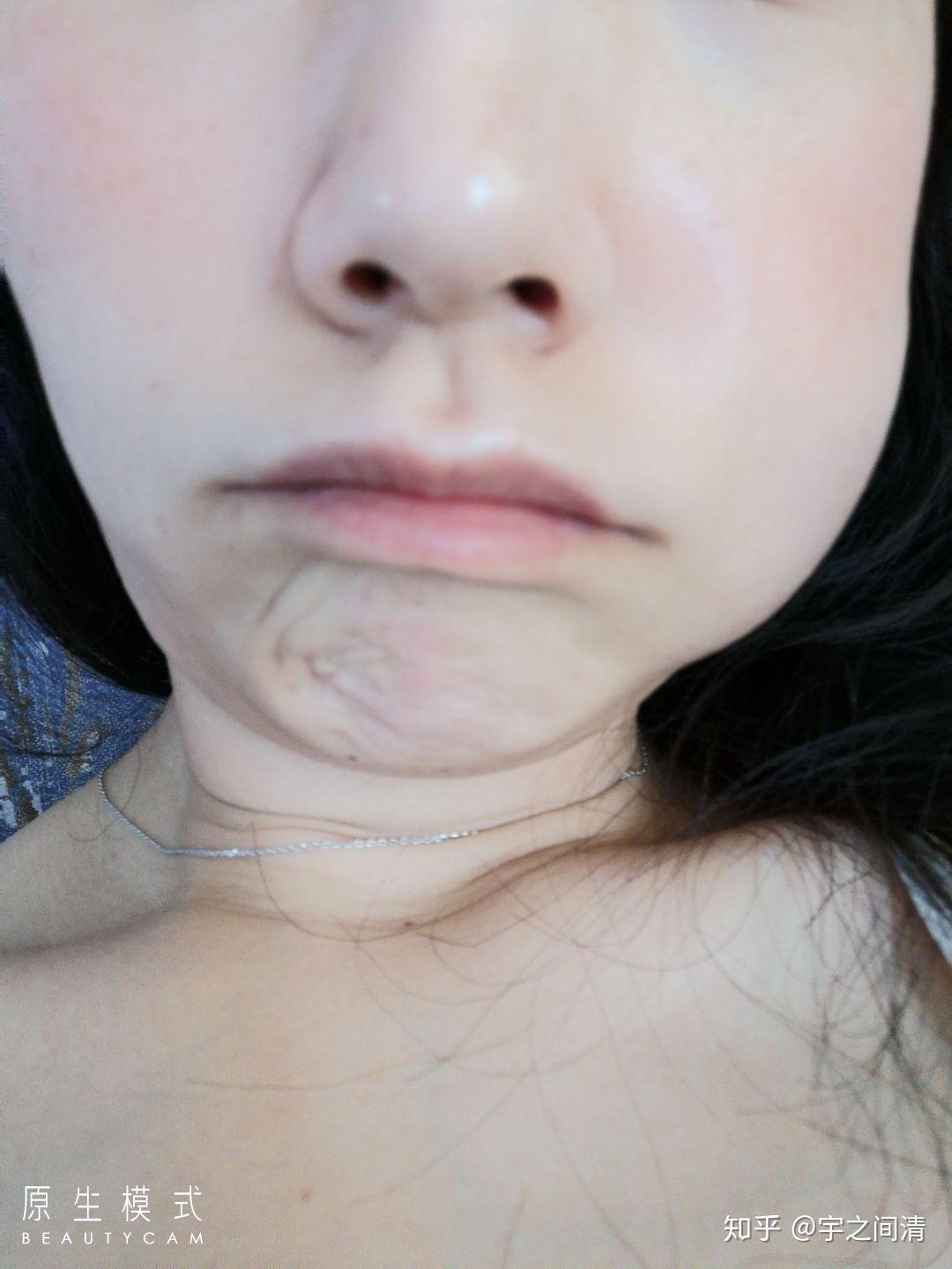 拔水平阻生智齿,术后第二天脸肿了,请问几天能消肿? - 知乎