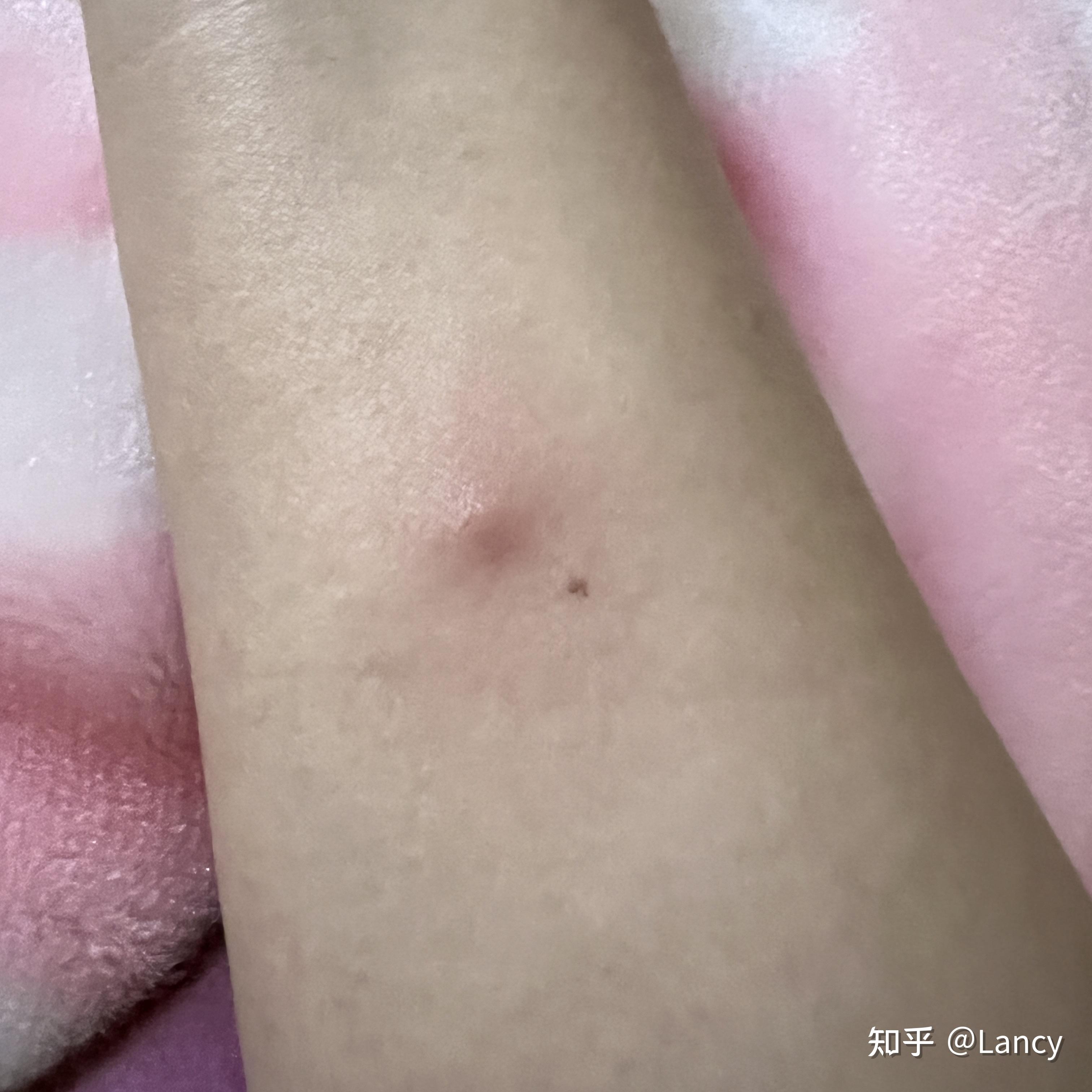 手臂内侧突然长了一个鼓包,请问是什么?