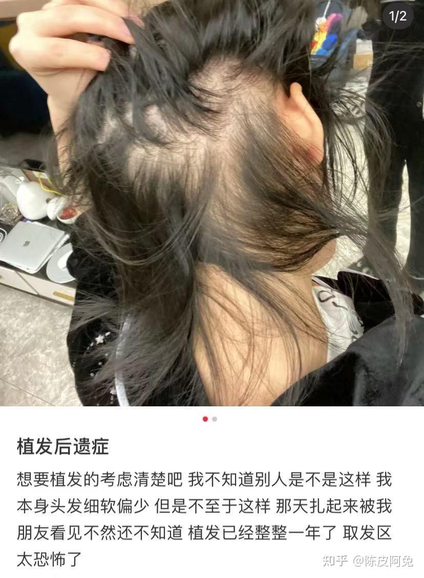 成都植发12天(成都植发吧 百度贴吧)