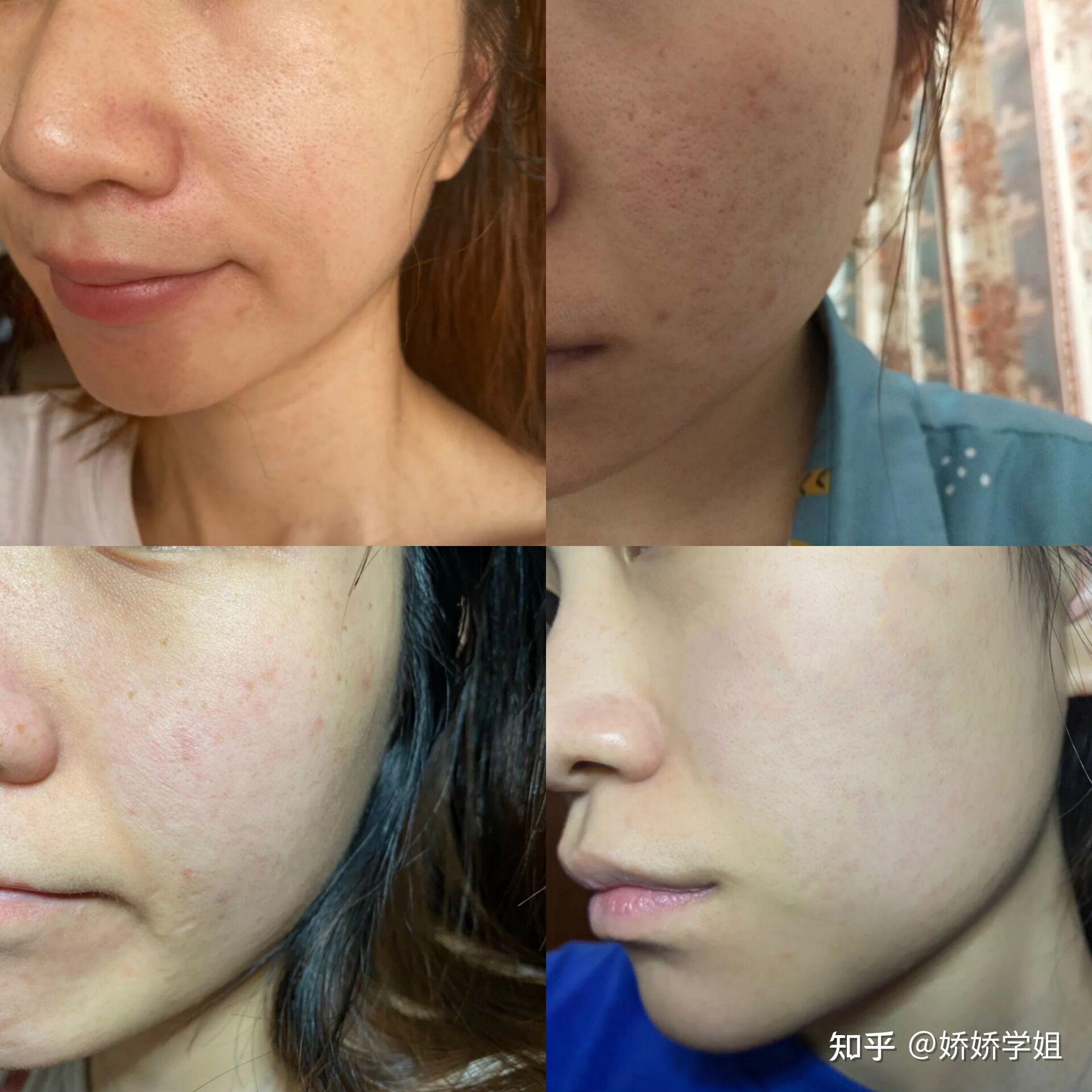 求救!23岁,毛孔粗大皮肤还有救吗? - 知乎