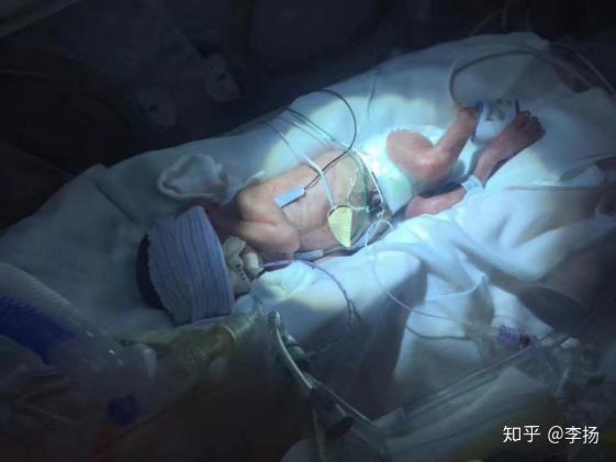 26周早产宝宝幸运存活