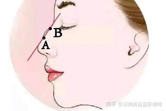 驼峰鼻怎么改善?玻尿酸隆鼻有没有效果?答案都在这里! - 知乎
