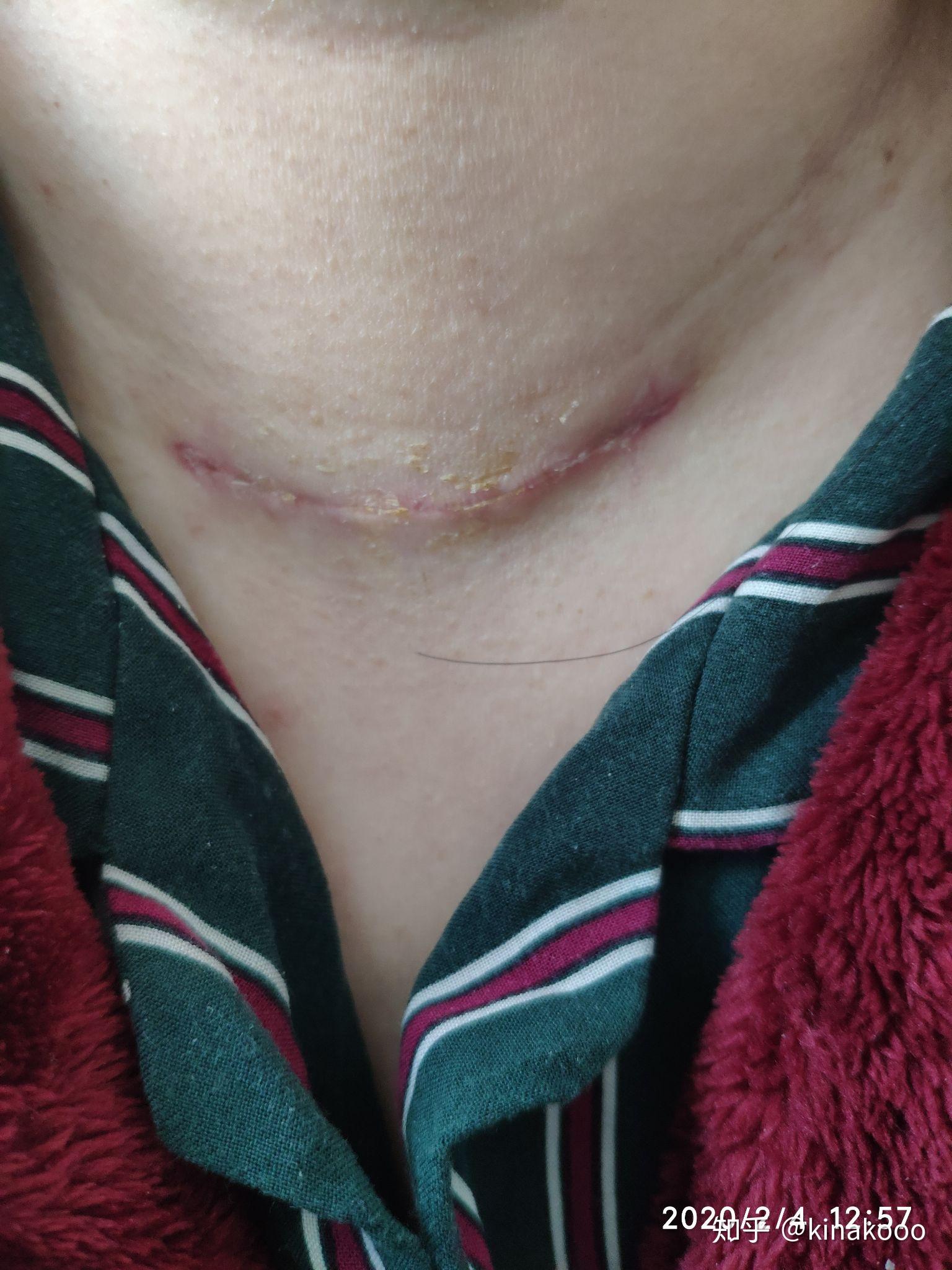 甲状腺全切是怎样的体验? - 知乎