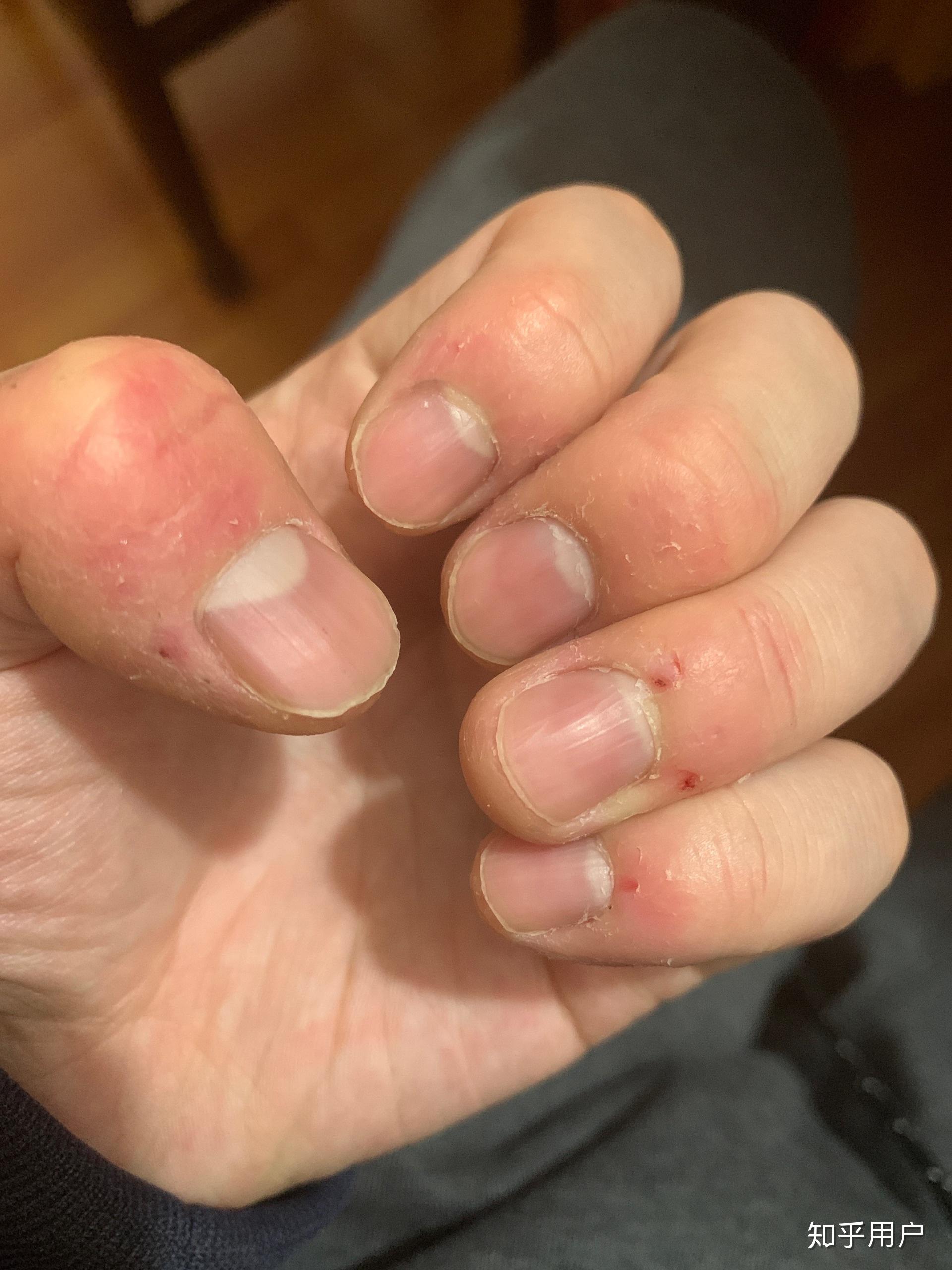 成年人如何停止啃手指的行为? - 知乎