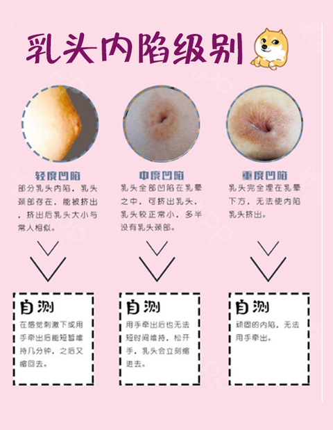 乳頭凹陷