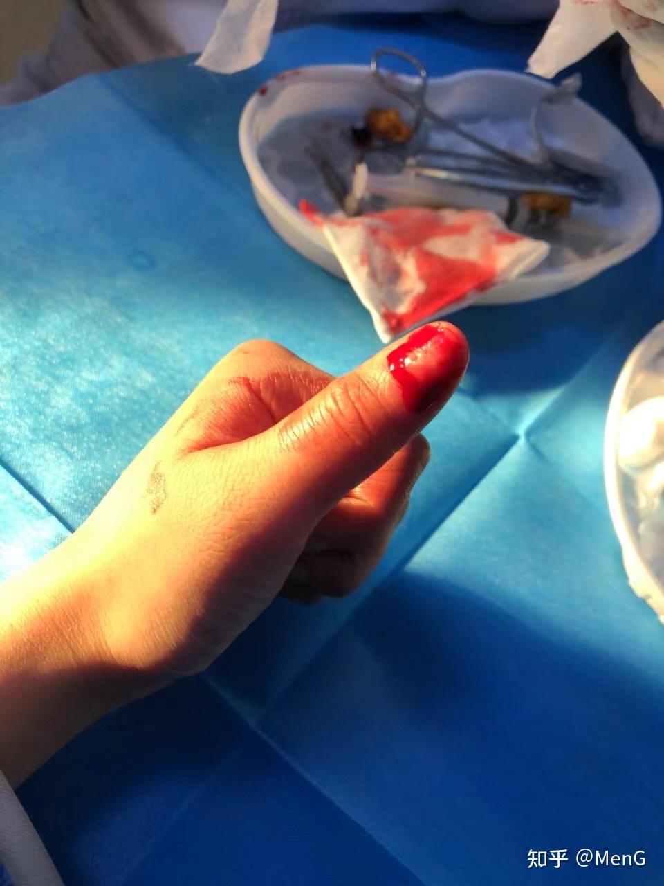 手指被夹指甲淤血图片