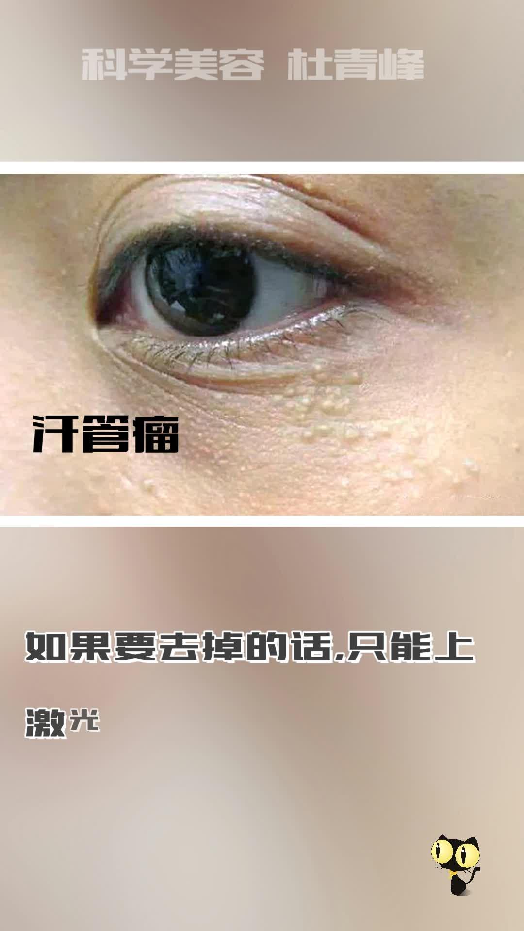 这种方法去除汗管瘤很简单,比想象中消退更好