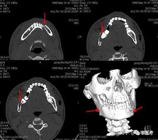 下颌骨双侧骨折下颌骨骨折左上:颚骨骨折左下:上颌窦前壁骨折右下