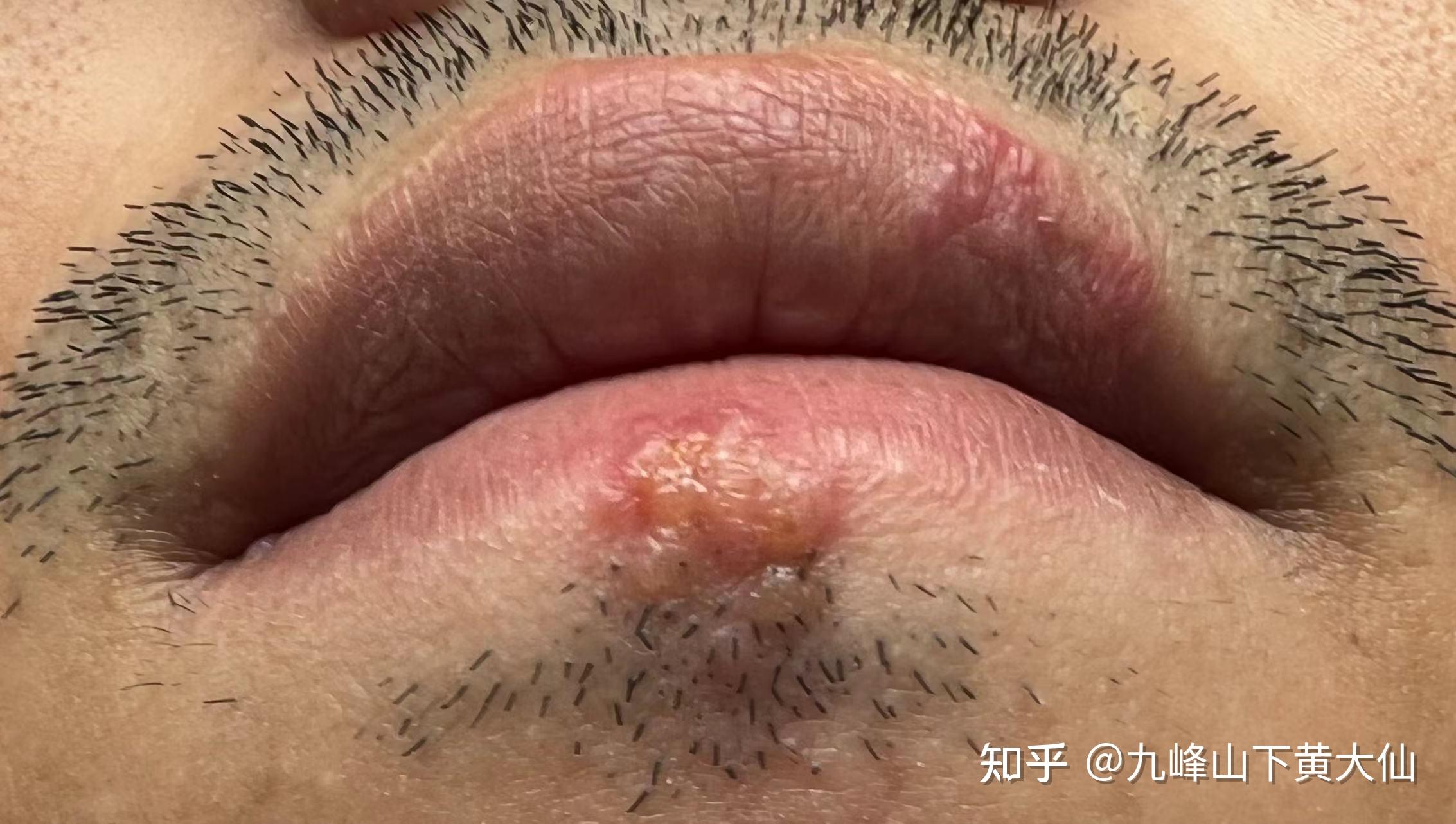 嘴上长泡纪实配图慎入