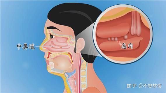 3,感觉源性鼻塞:主要有鼻阈狭窄,鼻中隔偏曲,鼻息肉,下鼻甲肥大,泡性