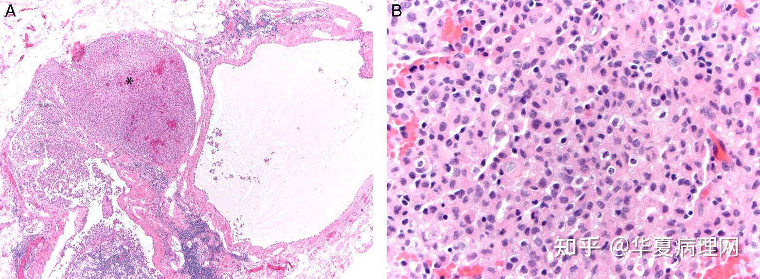 病理医师反间计之心包间皮瘤(二)
