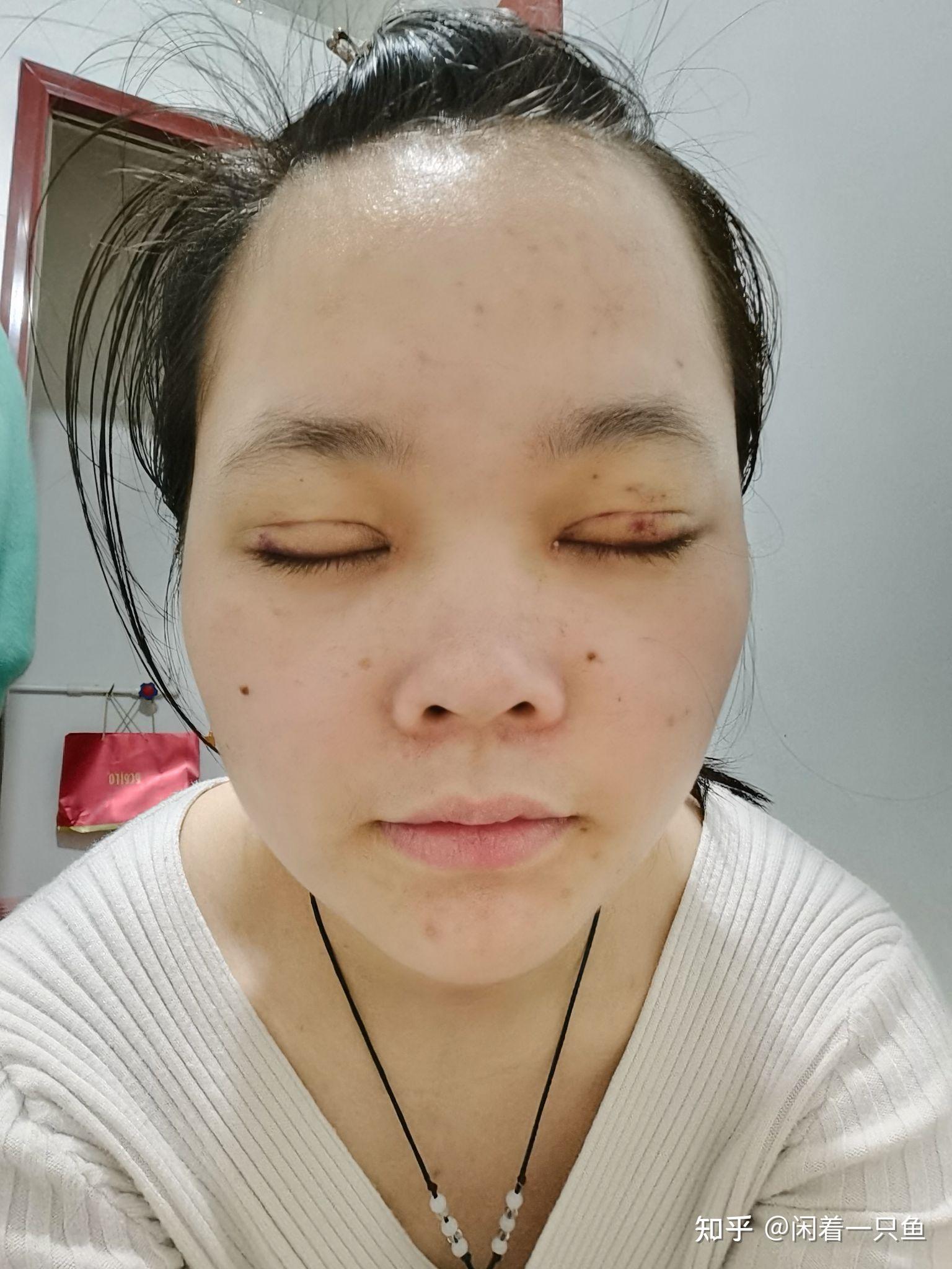 韩式微创双眼皮恢复过程 - 知乎