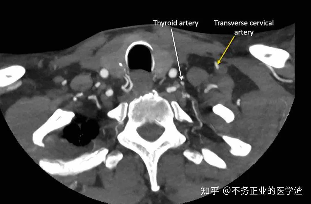 内乳淋巴结ct片图解图片