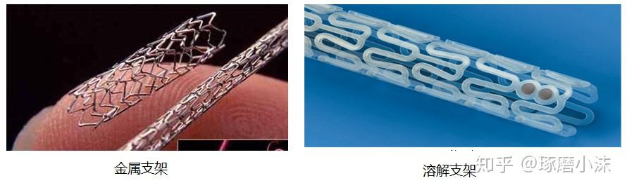 可降解心脏支架在国内为什么迟迟不上市?难道是我国医疗技术跟不上?