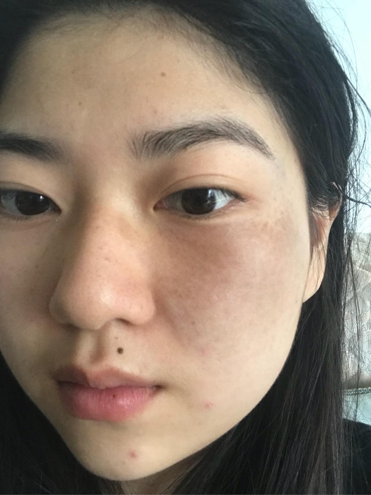 脸上有胎记是一种怎样的体验