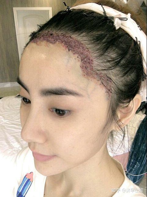 植发小日记做个完美的女孩你还不心动