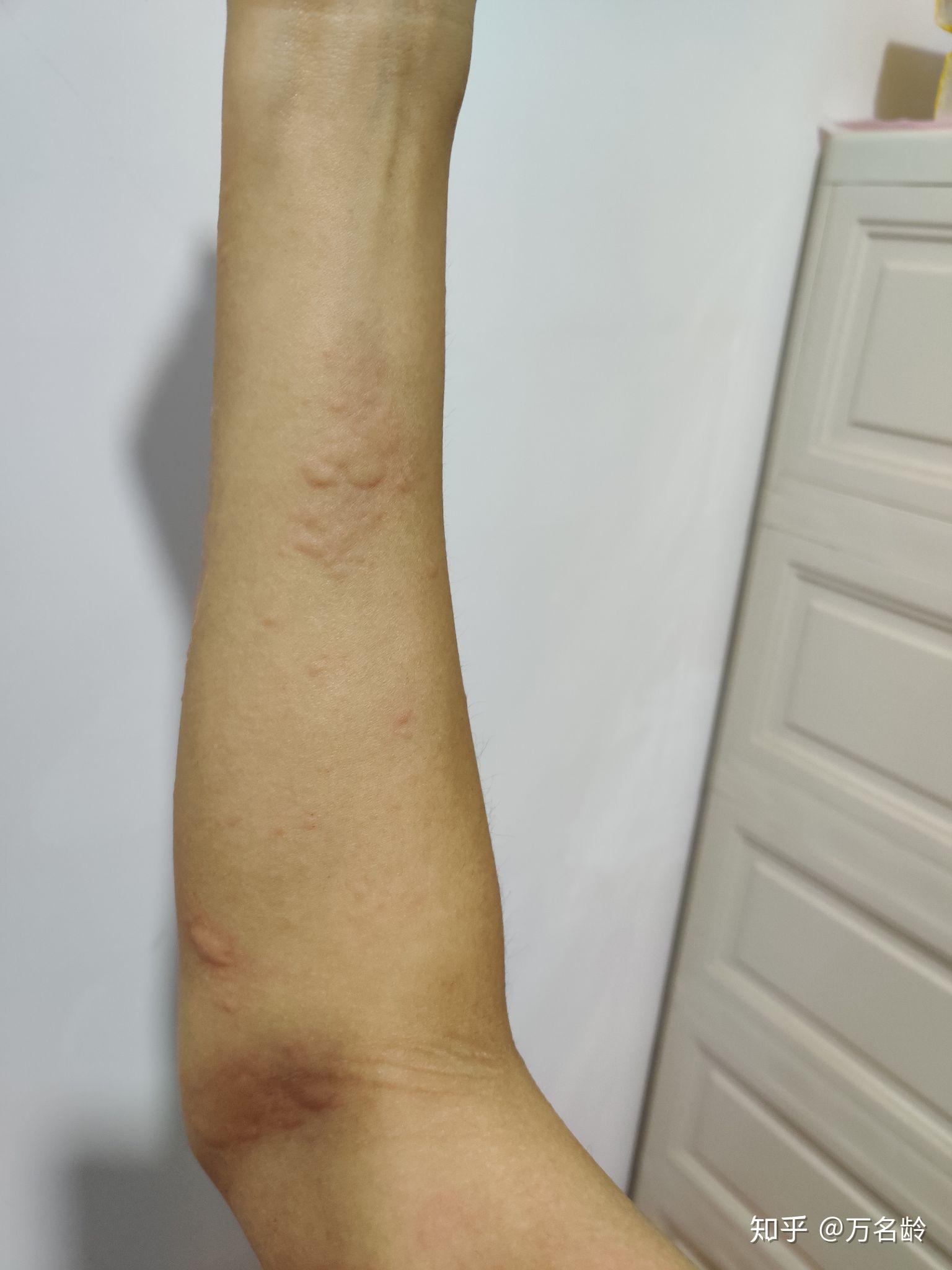 对狗过敏的症状有哪些
