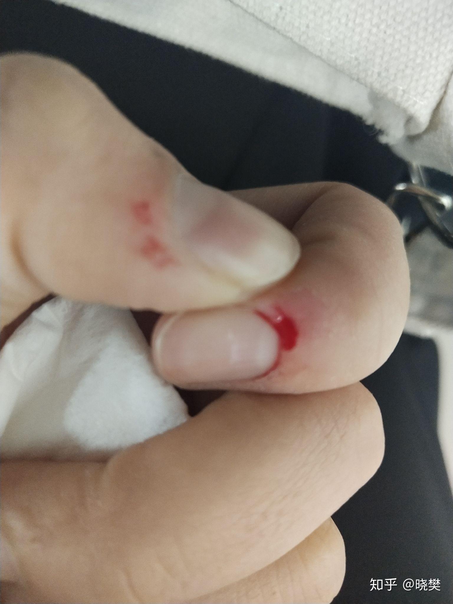 为什么我会喜欢撕手上的倒刺每次都会把自己弄的血淋淋的这是一种病吗