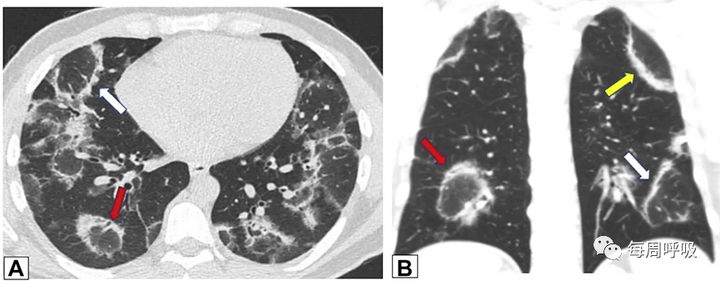 图片[16]-CHEST综述：机化性肺炎的诊断流程（临床-影像-病理特征相关性） | 每周呼吸-每周呼吸