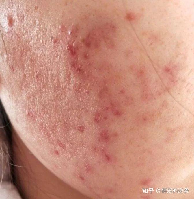 熬夜爆痘那是不存在滴!